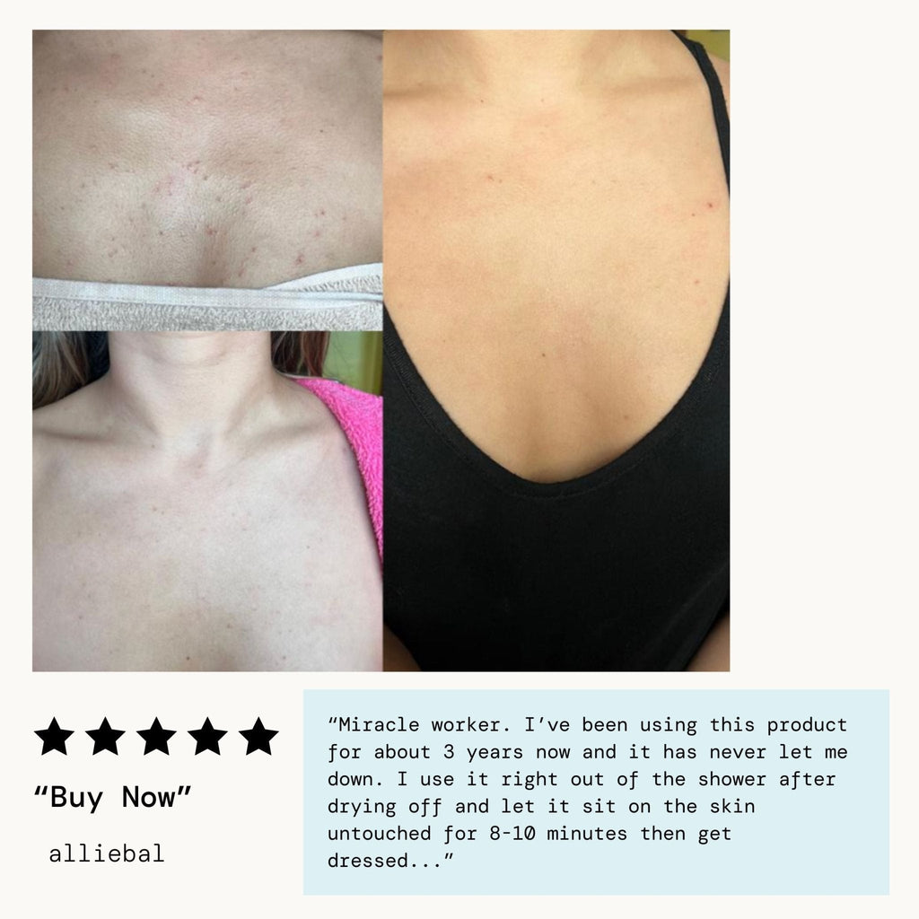 Bacne Warrior Acne Fighting Body Spray